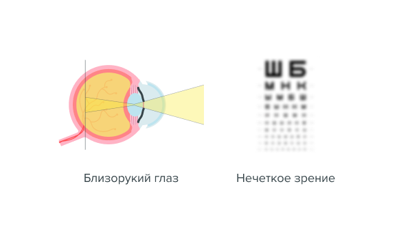 Близорукий глаз