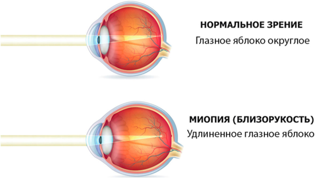 Нормальное зрение - глазное яблоко округлое. Миопия - удлиненное глазное яблоко.