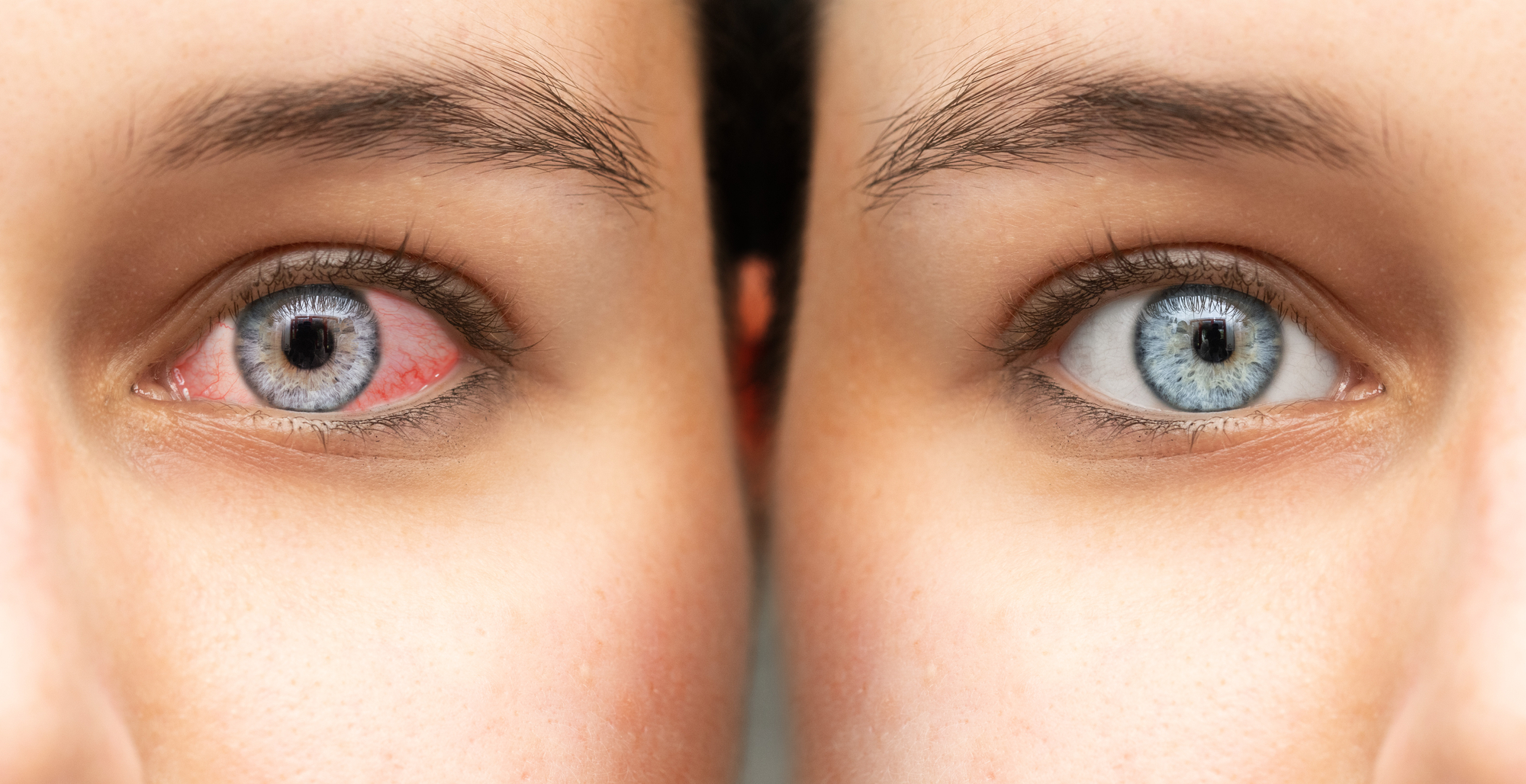 Глаз при аллергии