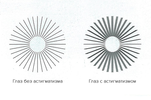 Глаз без астигматизма и с астигматизмом