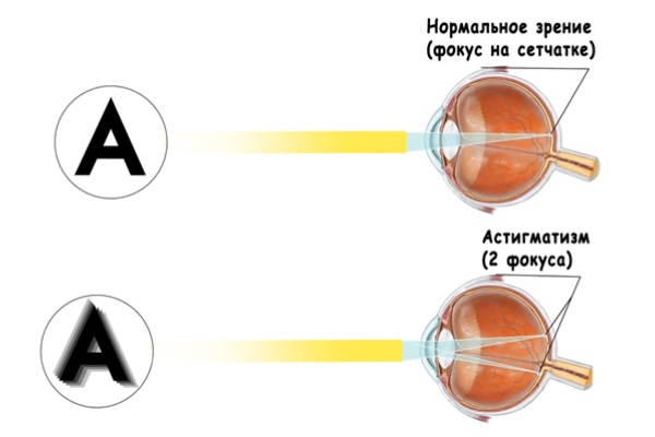 Как определить астигматизм
