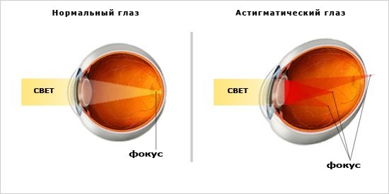 Нормальный и астигматический глаз
