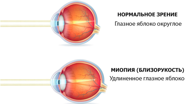 Нормальное зрение и миопия