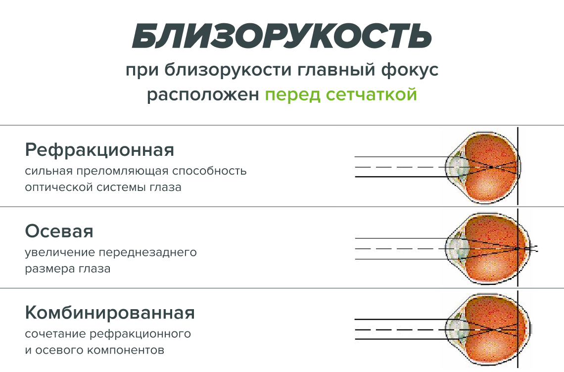 Виды близорукости
