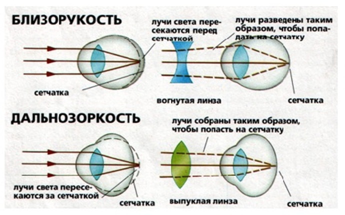 Близорукость и дальнозоркость