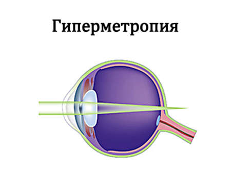 Гиперметропия