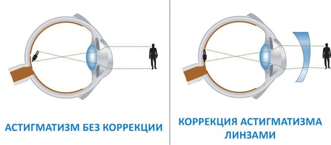 Астигматизм без коррекции. Коррекция астигматизма линзами
