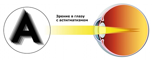 Зрение в глазу с астигматизмом