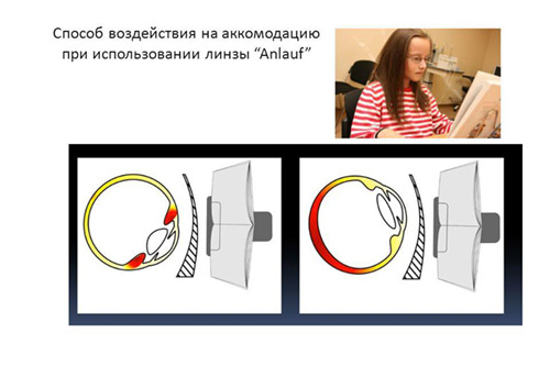 Способ воздействия на аккомодацию при использовании линзы 'Anlauf'