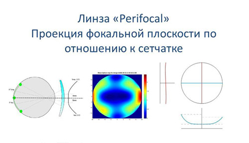 Линза 'Perifocal' Проекция фокальной плоскости по отношению к сетчатке