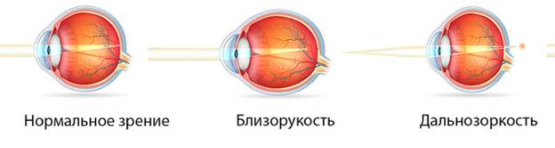 Виды заболеваний глаз, близорукость, дальнозоркость