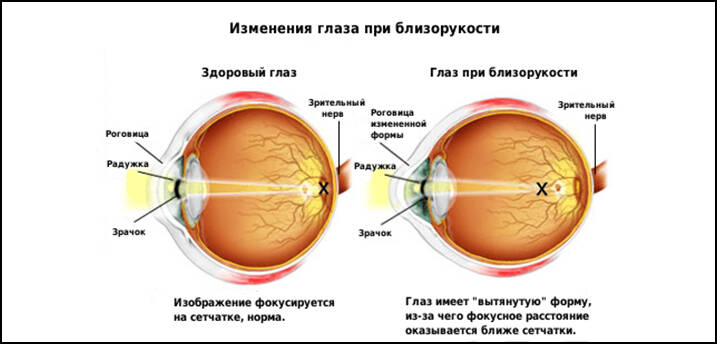 Изменение глаза при близорукости
