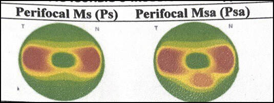 Perifocal