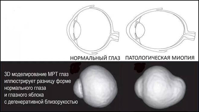 Нормальный глаз, патологическая миопия