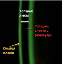 Биомикроскопическая картинка сравнения толщины 