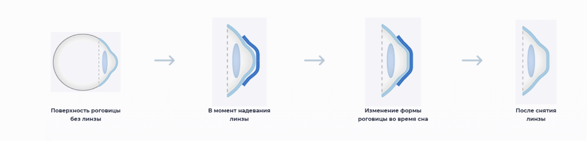 Действие ночных линз